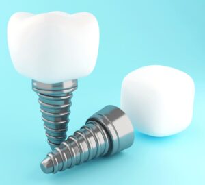 3d dental tooth implant 2021 08 29 10 14 31 utc