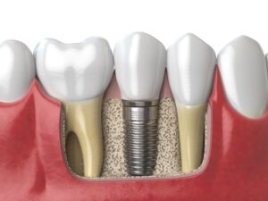 anatomy of healthy teeth and tooth dental implant 2021 08 26 16 56 57 utc 1