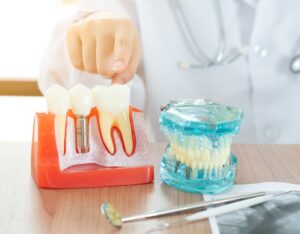 dentist with dental implant model 2021 08 29 01 04 50 utc 1 1