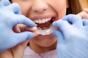 invisible braces 2021 08 26 22 28 12 utc 1
