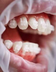 white orthodontic brackets on patient teeth 2022 05 28 10 47 38 utc